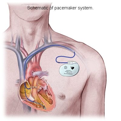 Pacemakers